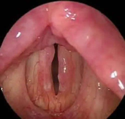 تاثیر رفلاکس معده بر حنجره و صدا
