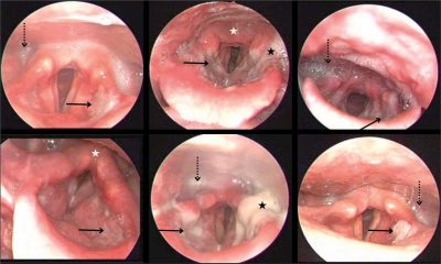درمان التهاب و لارنژیت حنجره - معرفی انواع داروی لارنژیت